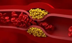 Kolesterolün varlığından habersiz olduğunuzu gösteren 5 işaret