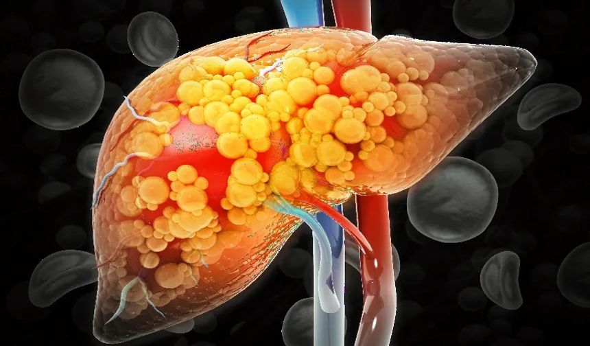Yağlı karaciğer, sadece yaşam tarzı değişikliğiyle iyileştirilebilir mi?
