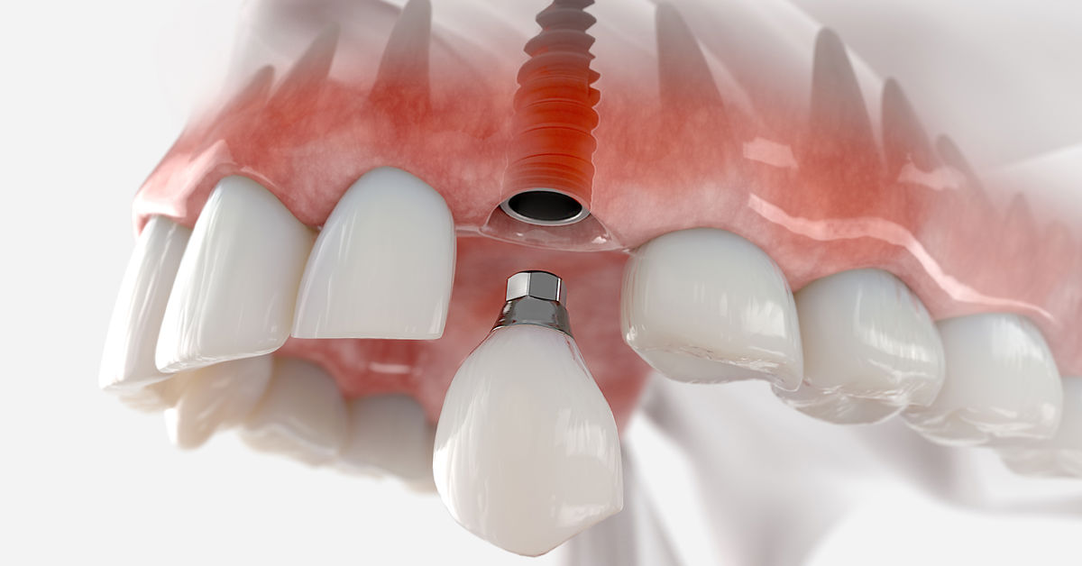 1 Gunde Implant Tedavisi 2